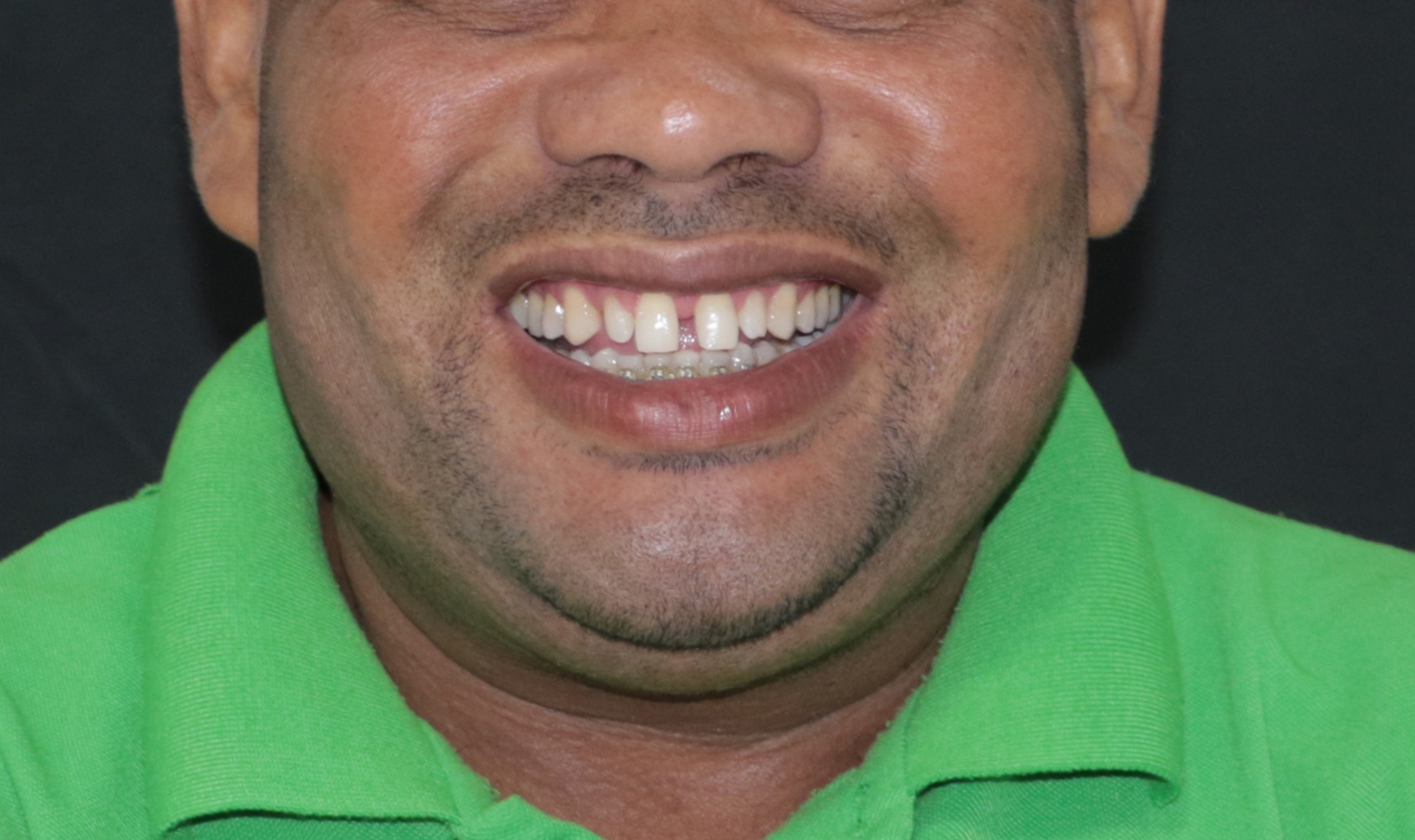 Antes - Leony